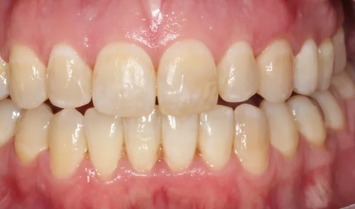 Patient 1 teeth after clear aligner treatment
