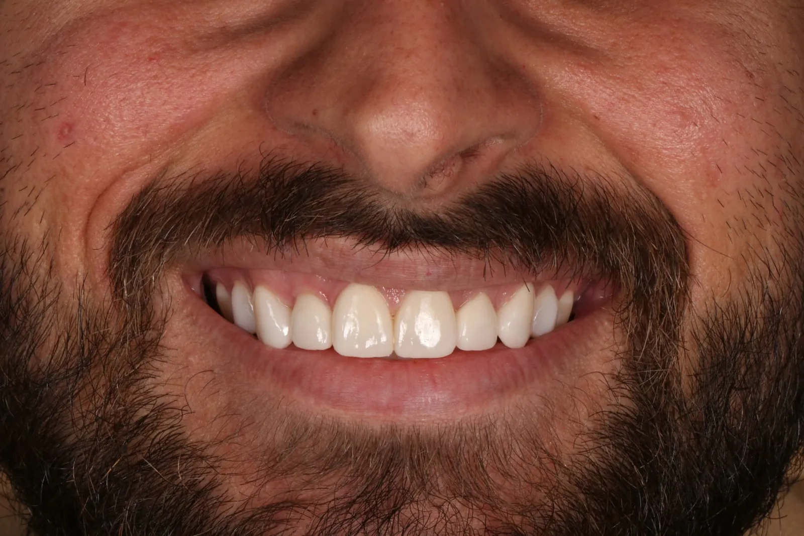 Patient 3 smile after porcelain veneer treatment