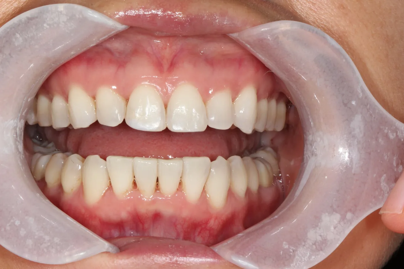 Patient 2 teeth after Invisalign treatment