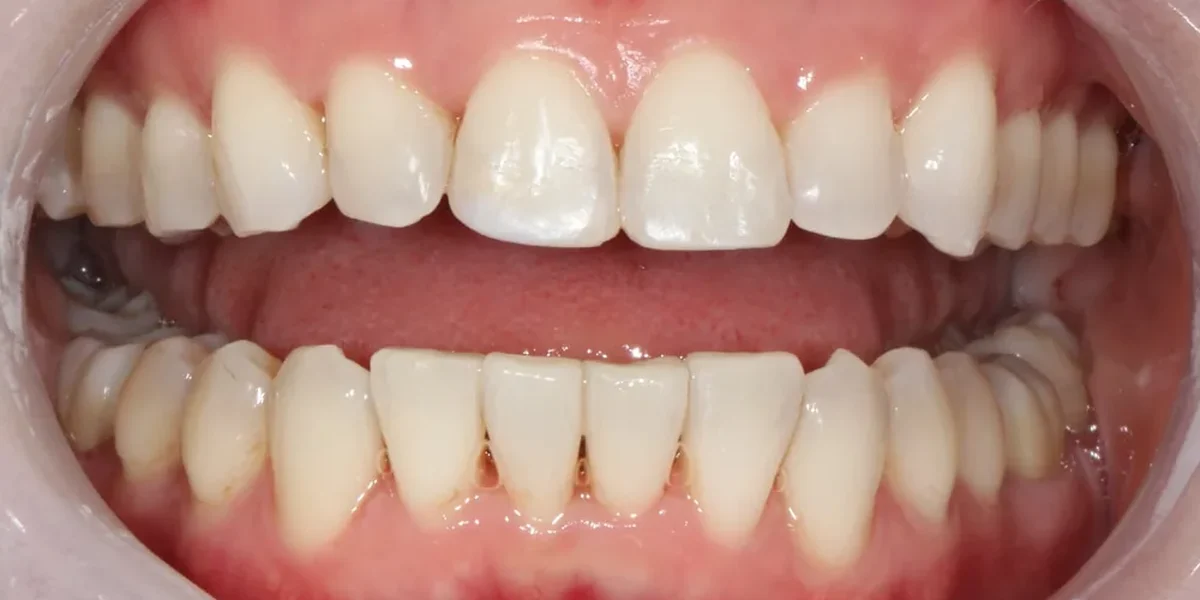 After clear aligner treatment