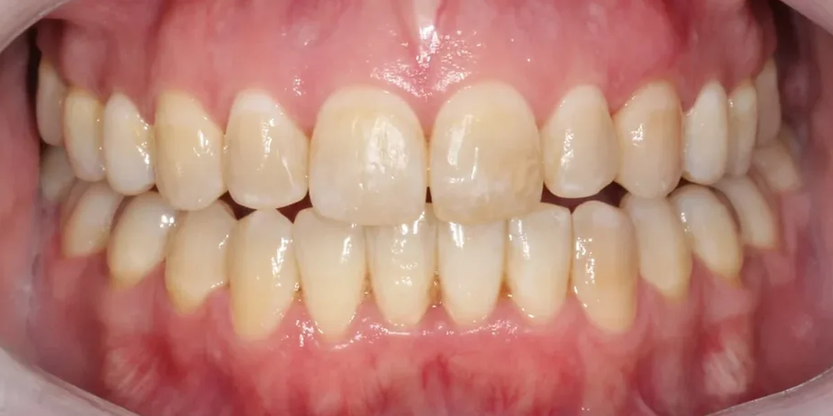 After clear aligner treatment
