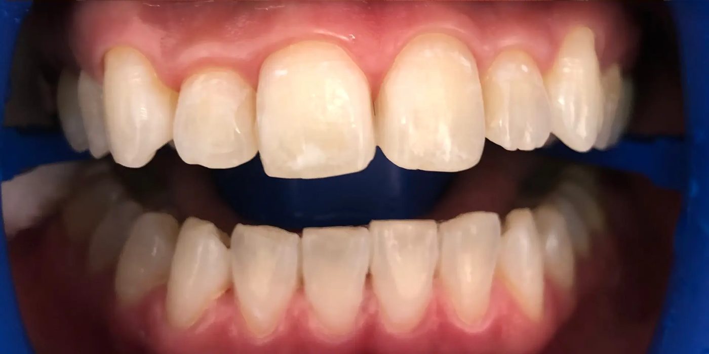Close-up of the same patient's teeth after professional whitening treatment at Nest Dental