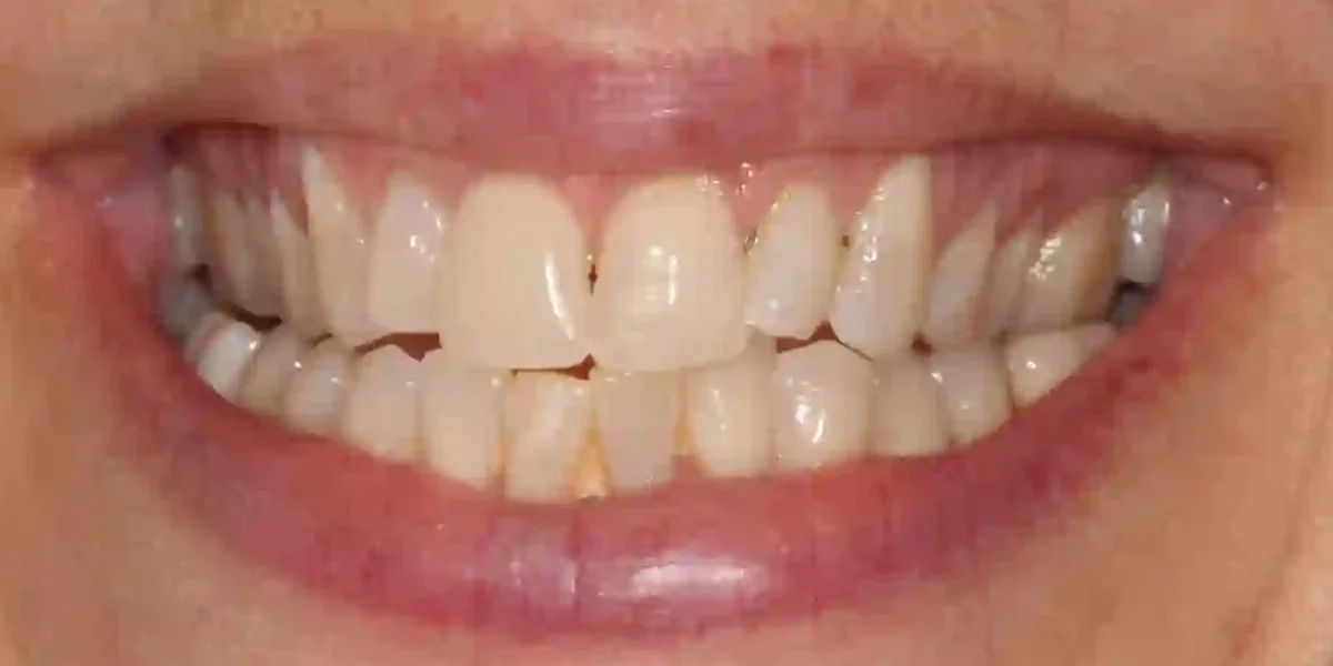 After clear aligner treatment