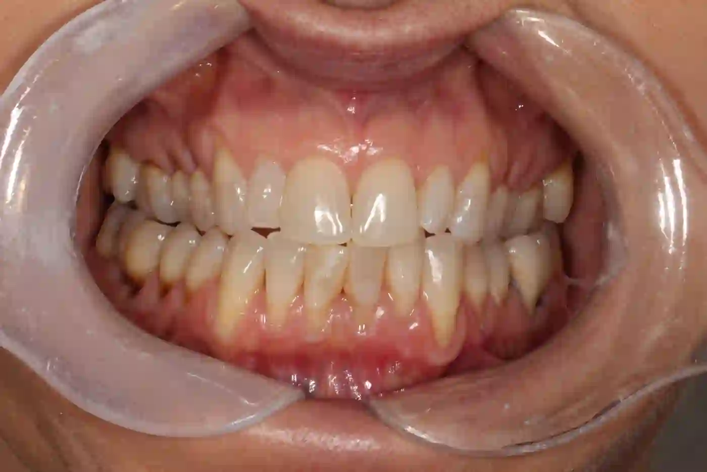 Patient 4 teeth before Invisalign treatment