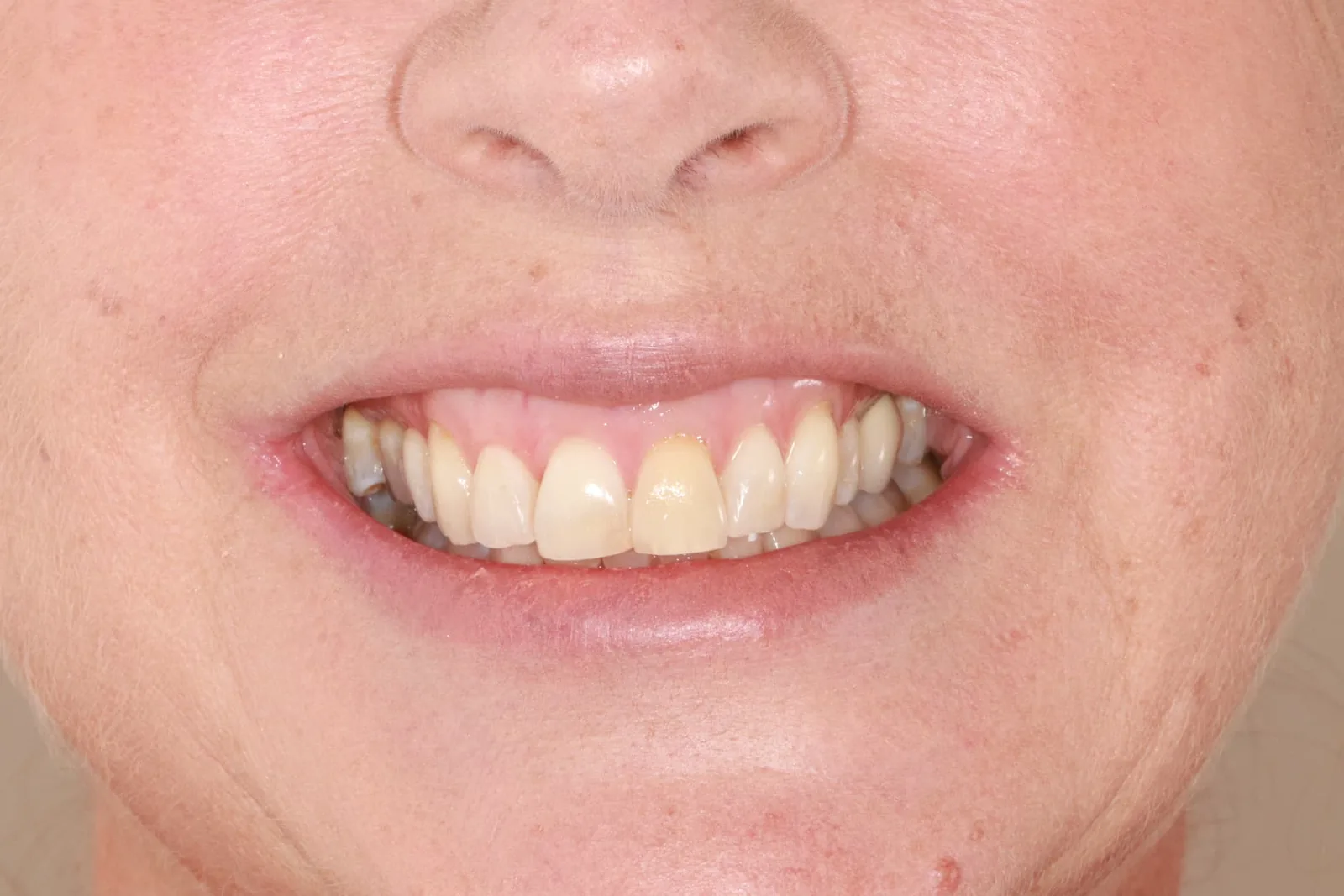 Patient 1 smile before porcelain veneer treatment