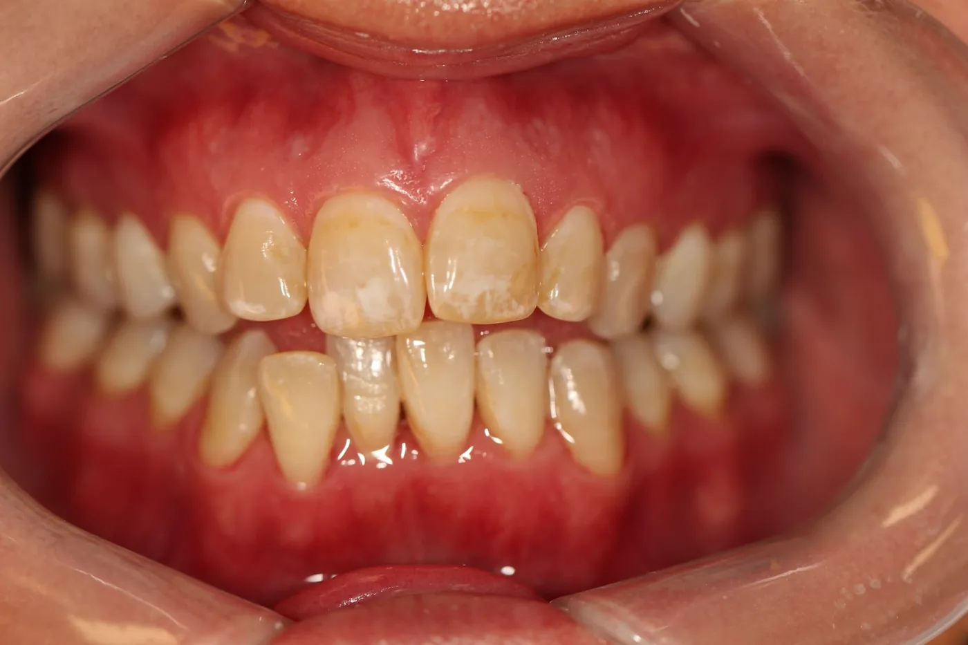 Patient 1 teeth before Invisalign treatment