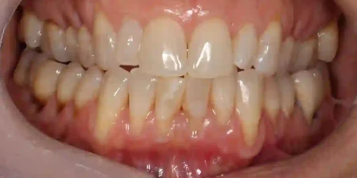 Before clear aligner treatment