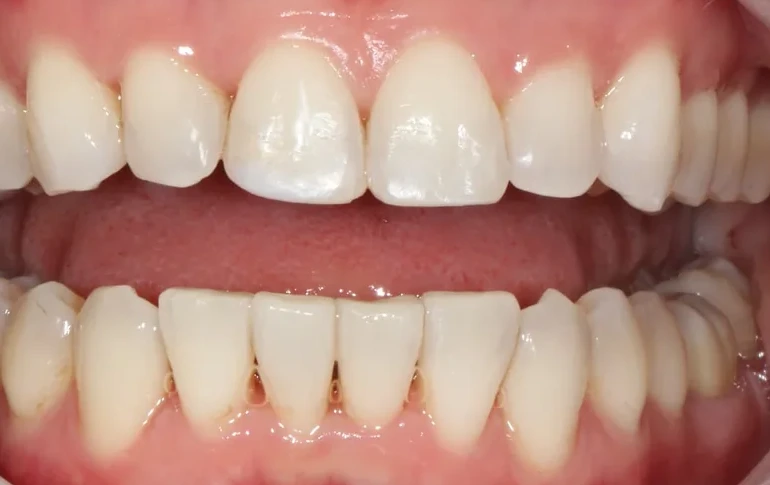 Patient 2 teeth after clear aligner treatment