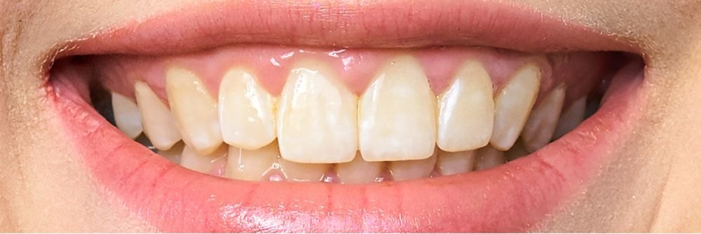 Close-up of a second patient's smile before professional whitening treatment at Nest Dental