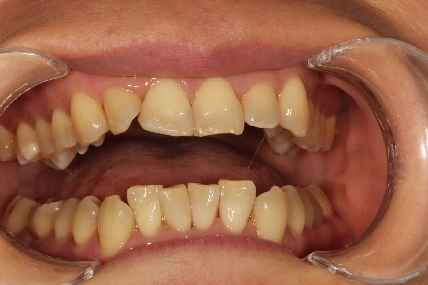 Patient 2 teeth before Invisalign treatment