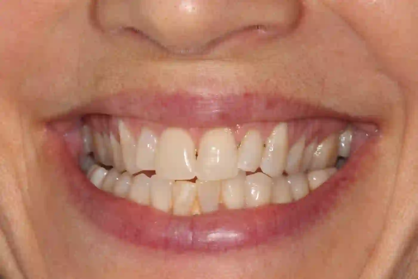 Patient 4 teeth after Invisalign treatment