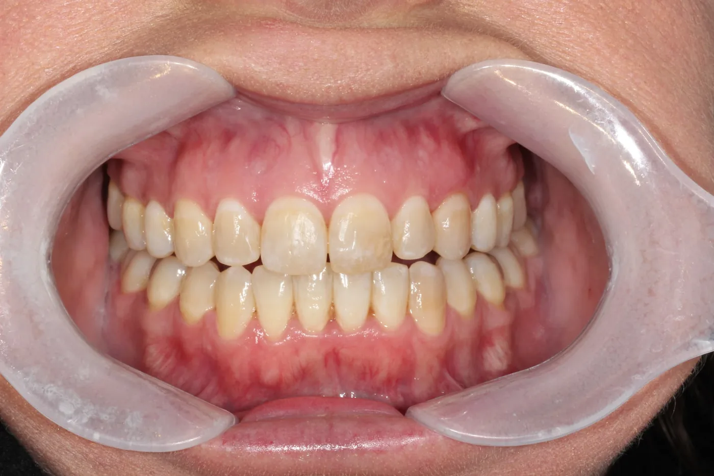 Patient 1 teeth after Invisalign treatment