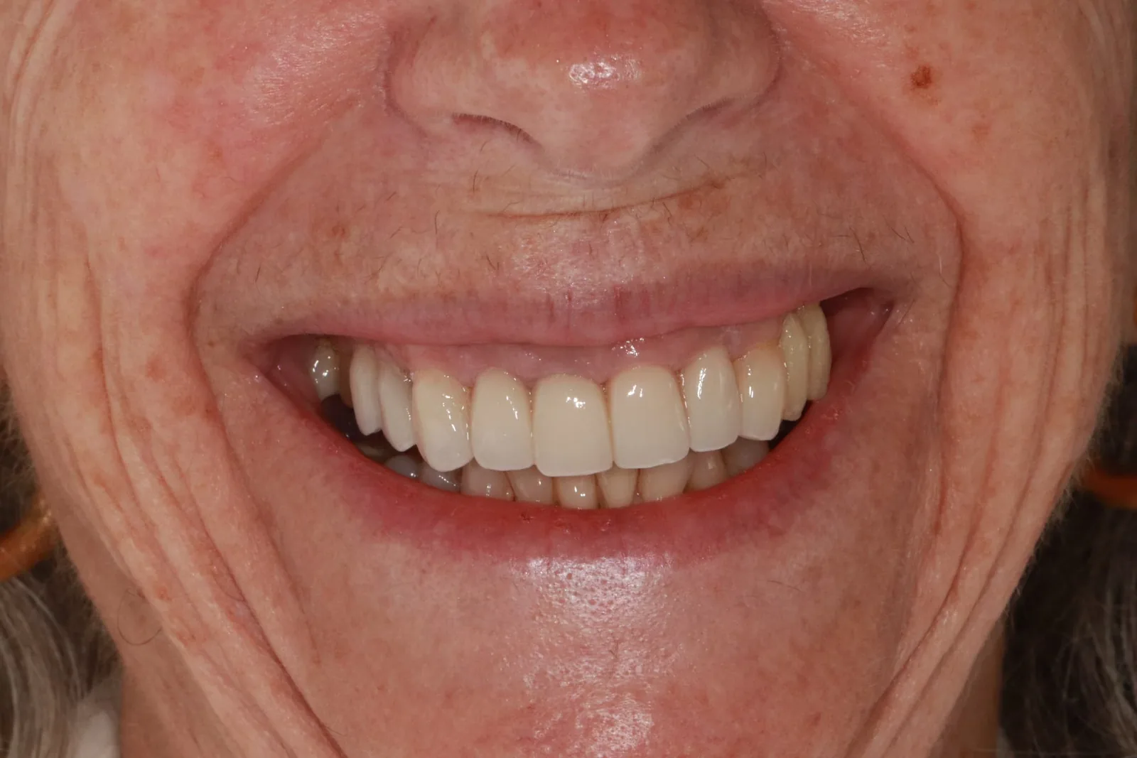 Patient 2 smile after porcelain veneer treatment