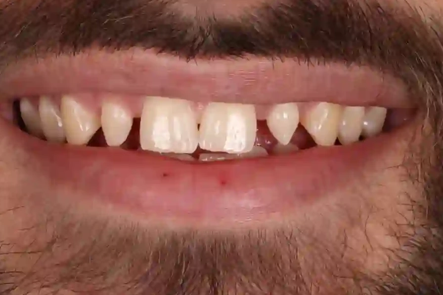 Patient 3 teeth before clear aligner treatment