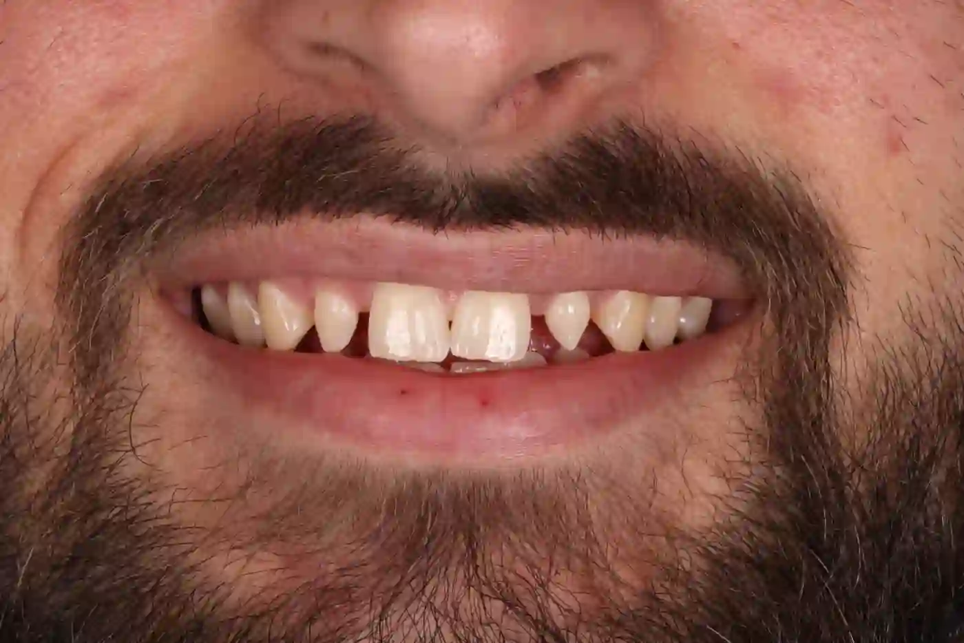 Patient 3 teeth before Invisalign treatment