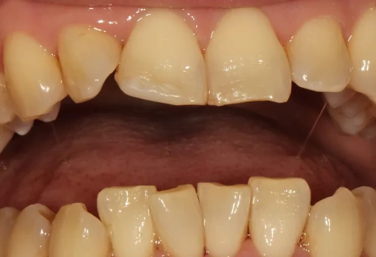 Patient 2 teeth before clear aligner treatment