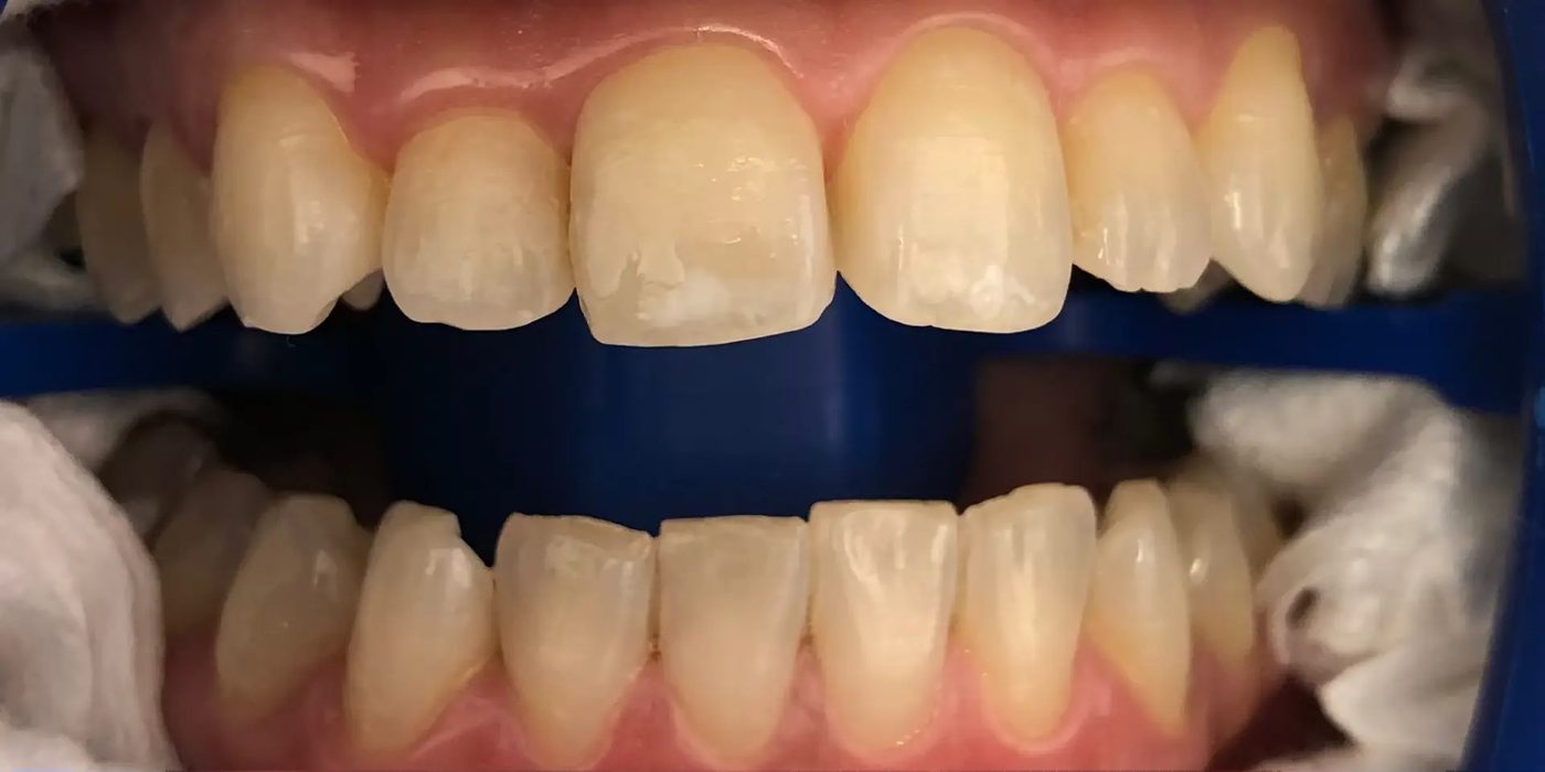 Close-up of a patient's teeth before professional whitening treatment at Nest Dental