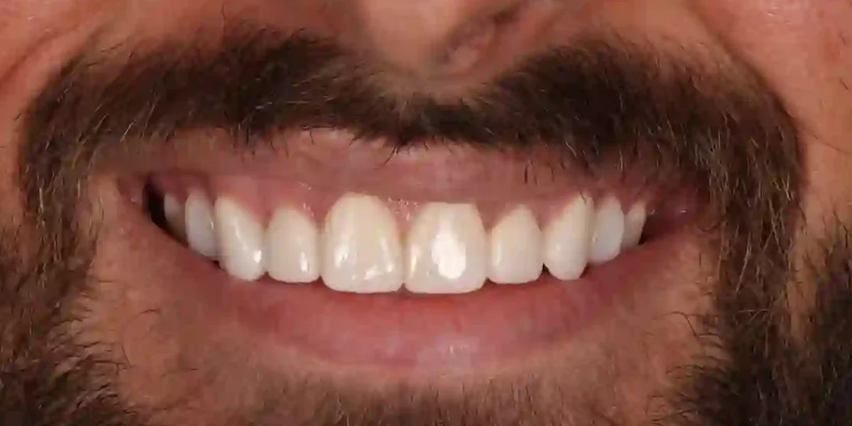 After clear aligner treatment