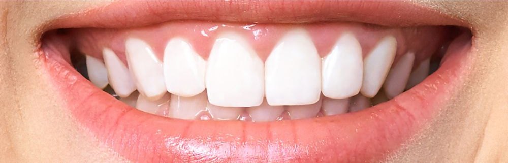 Close-up of the same smile after professional whitening treatment at Nest Dental