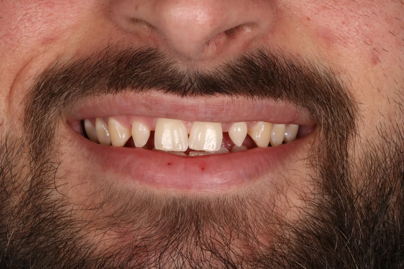 Patient 3 smile before porcelain veneer treatment