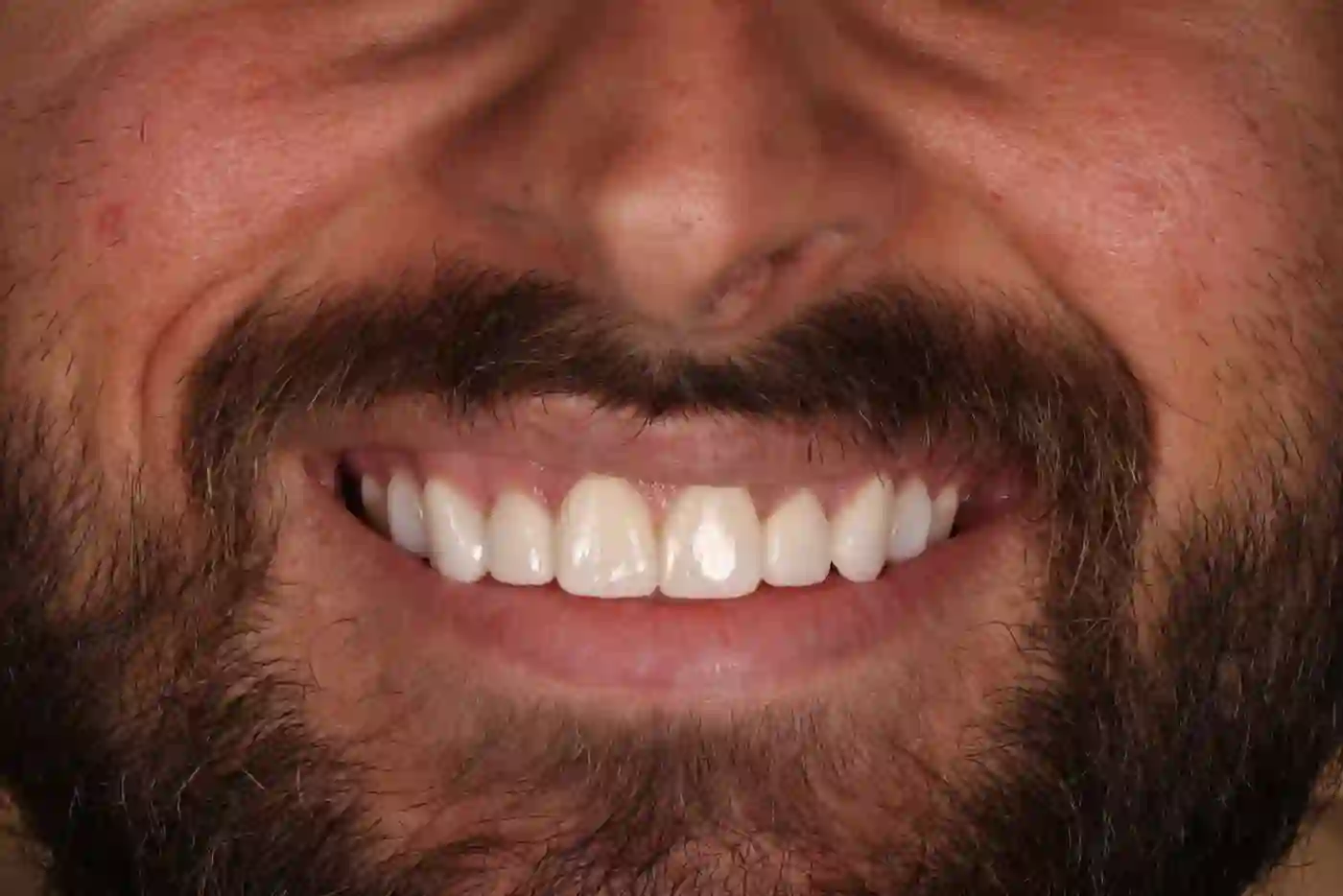 Patient 3 teeth after Invisalign treatment
