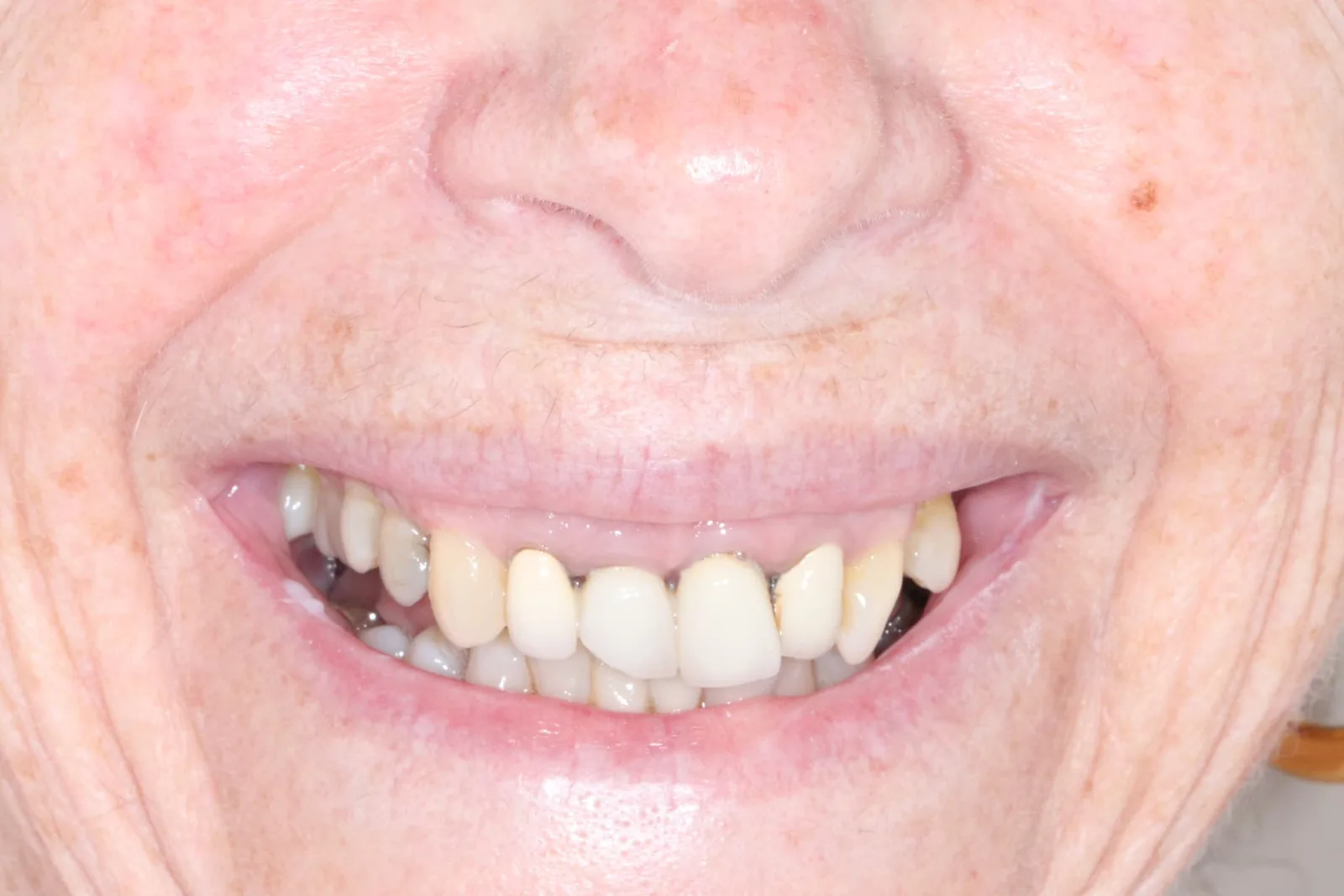 Patient 2 smile before porcelain veneer treatment