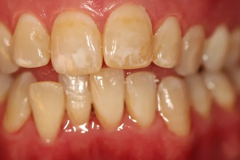 Patient 1 teeth before clear aligner treatment