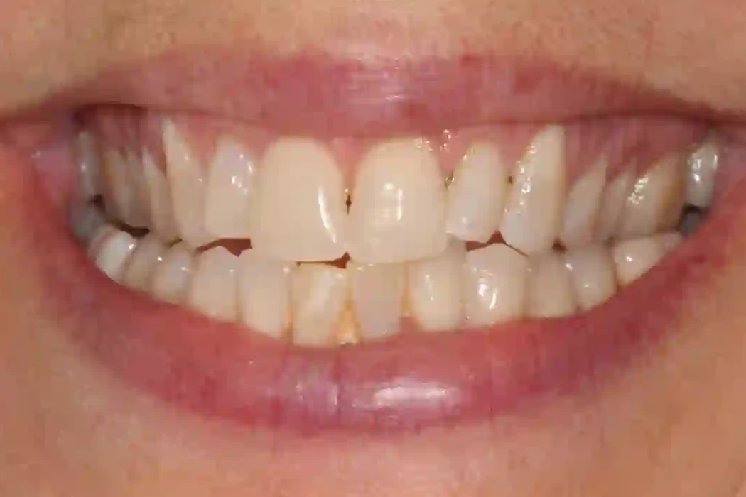 Patient 4 teeth after clear aligner treatment