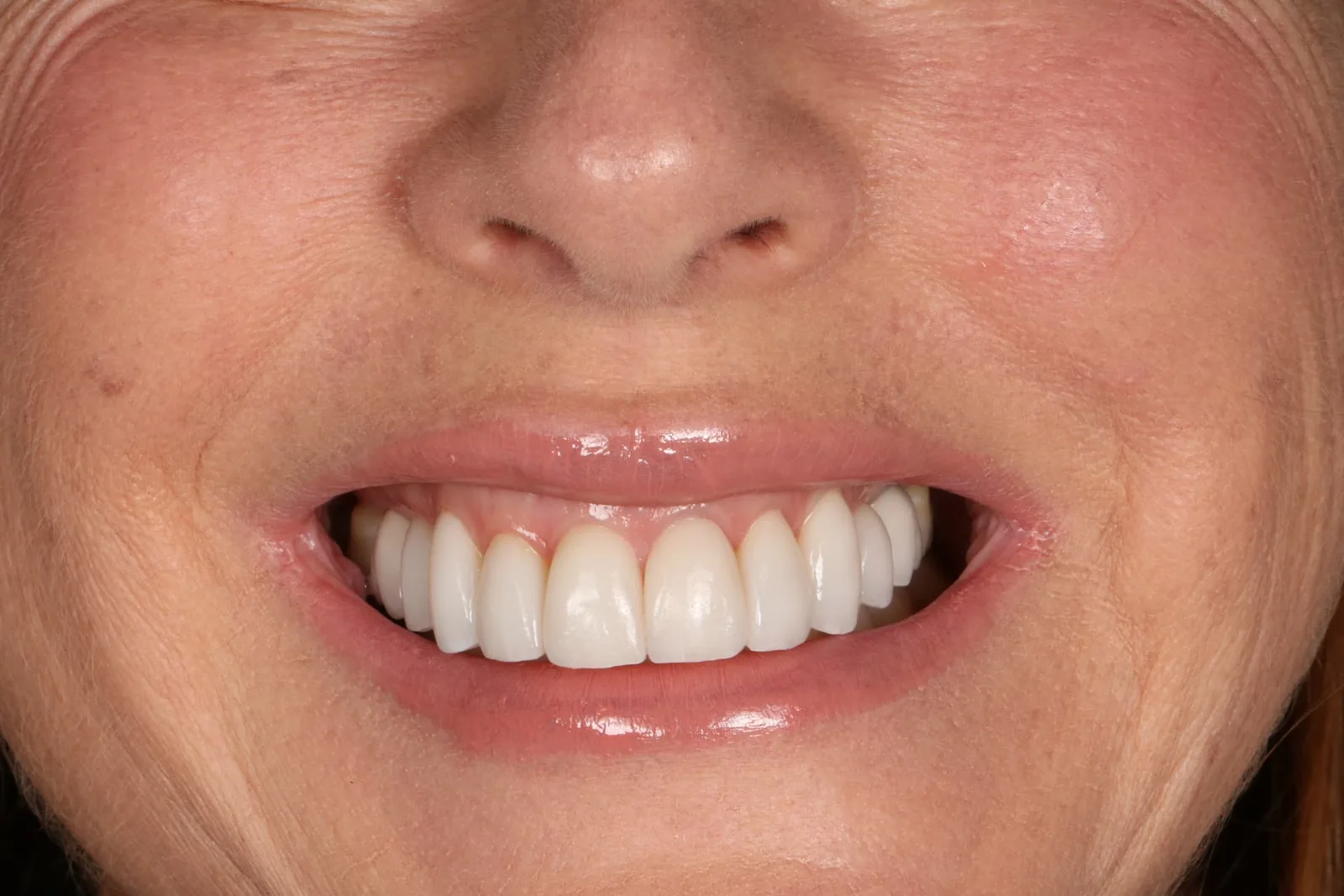 Patient 1 smile after porcelain veneer treatment