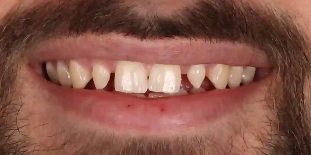 Before clear aligner treatment
