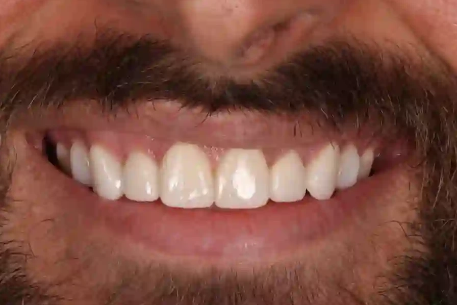 Patient 3 teeth after clear aligner treatment