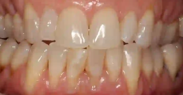 Patient 4 teeth before clear aligner treatment