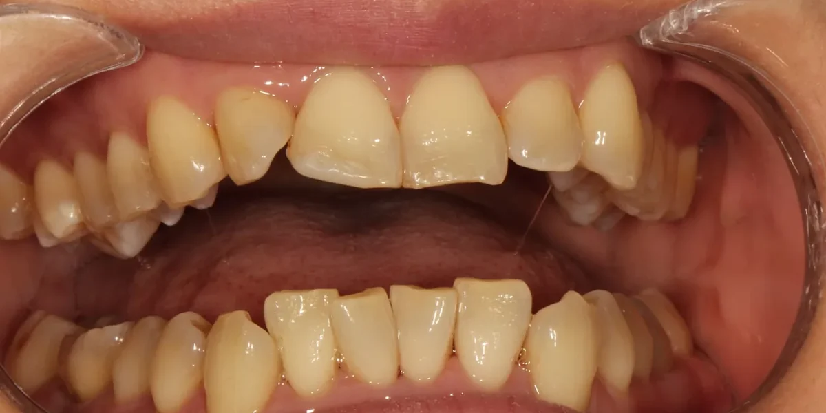 Before clear aligner treatment
