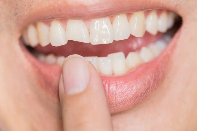 A chipped front tooth, seen while a person touches their lower lip