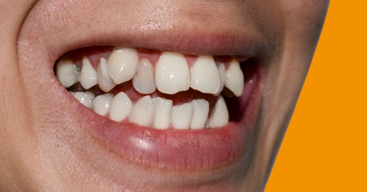 Close-up of an adult smile with crowded, overlapping teeth
