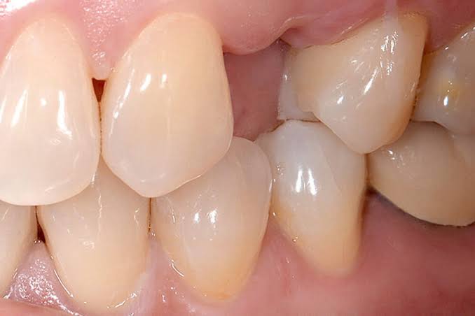 Close-up of a gap where an upper tooth is missing