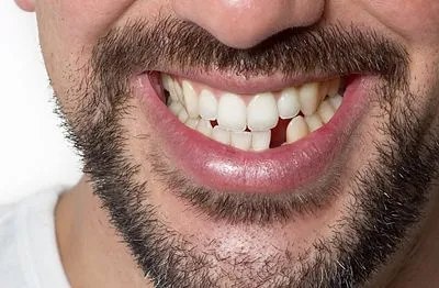 A man's smile showing a missing lower front tooth