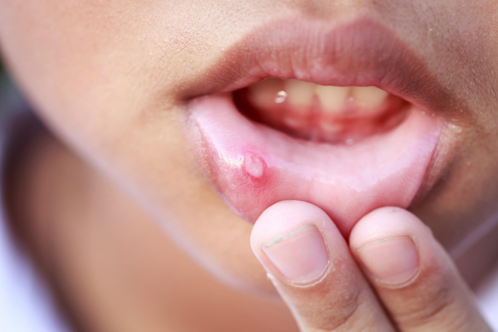 Close-up of a small mouth ulcer on a person's lower lip