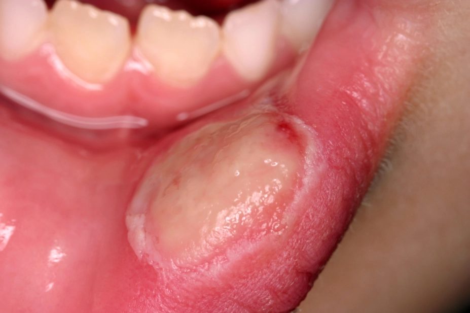 A mouth ulcer on the inside of the lip, seen during a dental examination
