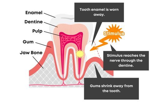 Diagram of a tooth in cross-section showing how a stimulus reaches the nerve through the dentine