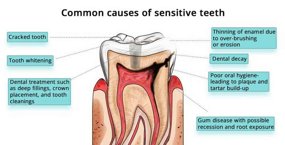 Diagram listing common causes of sensitive teeth, from cracked tooth to gum disease