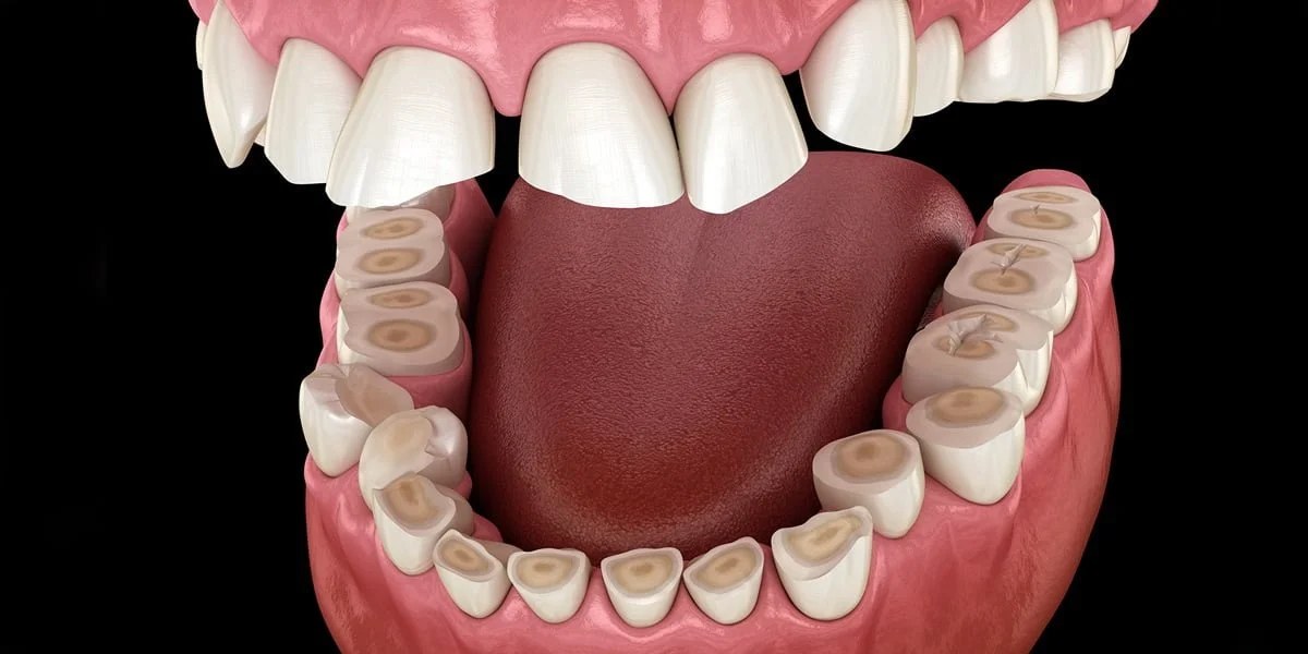 3D illustration of teeth worn down by grinding, with flattened surfaces