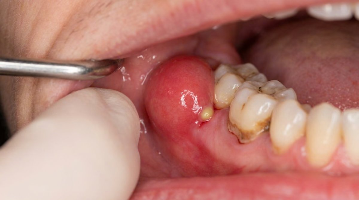A swollen gum abscess next to a molar, seen during a dental examination