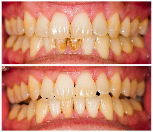 Close-up of yellowed teeth before and after a clean